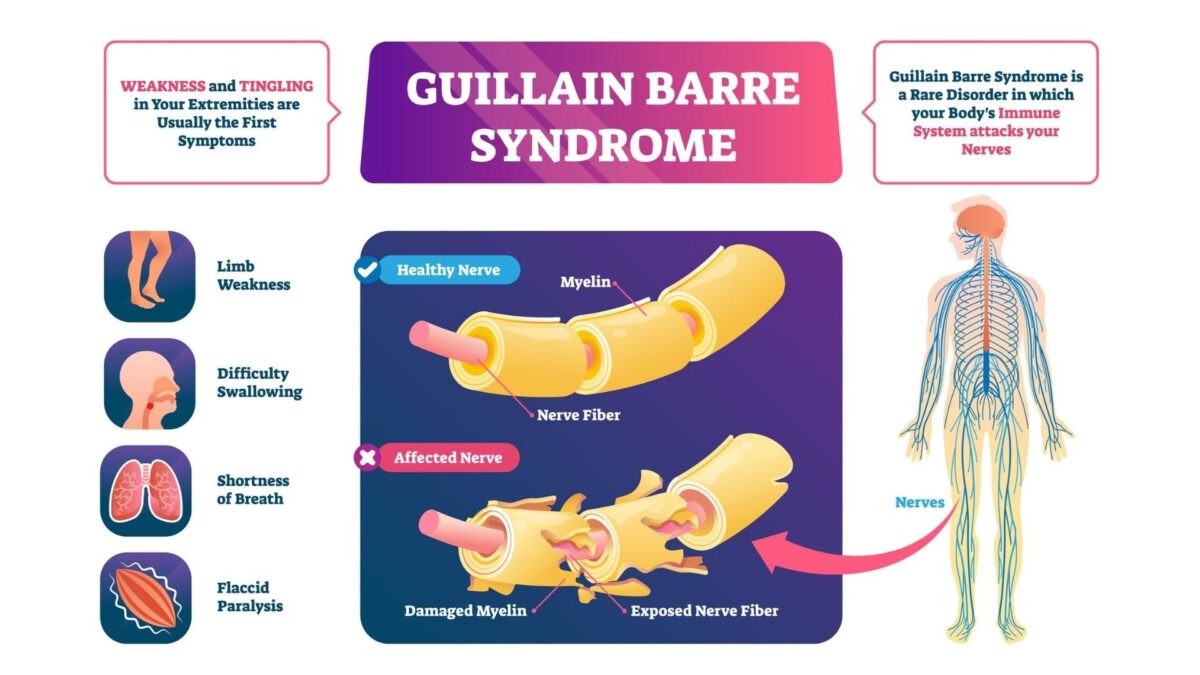 Guillain-Barre Syndrome (GBS) Therapy